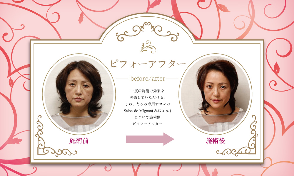 みにょんの施術のビフォーアフター一覧はこちらをクリック